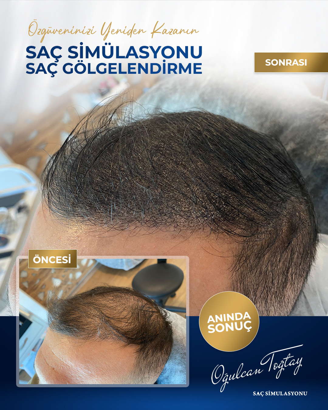 OĞULCAN TOĞTAY _2 BEFORE AFTER MAVİ