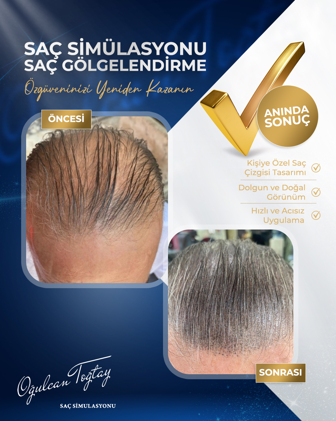 OĞULCAN TOĞTAY _4 BEFORE AFTER