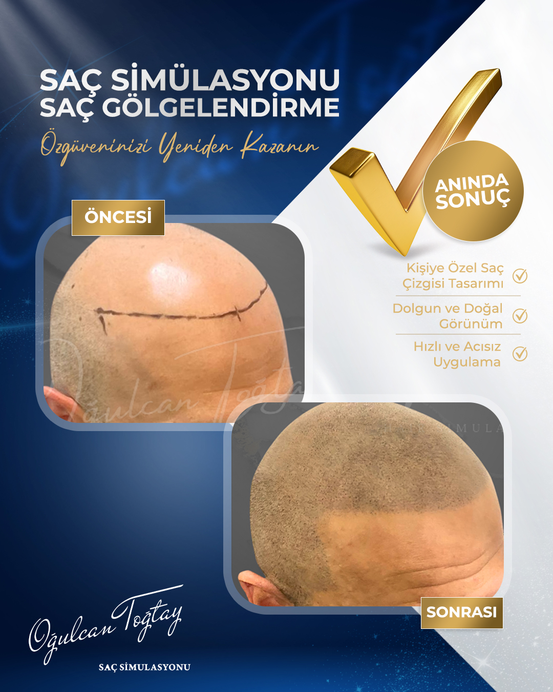 OĞULCAN TOĞTAY _5 BEFORE AFTER (1)